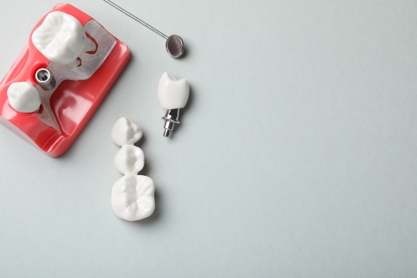 Key Differences: Dental Bridges Vs  Dental Crowns