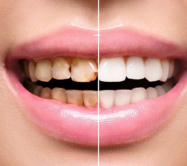 Temecula Dental Implant Restoration